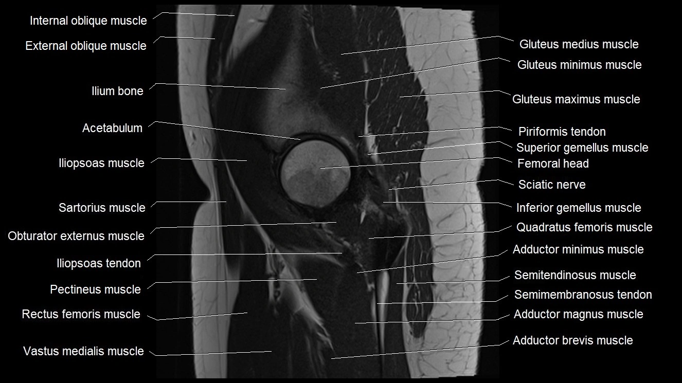 Hip sagittal cross sectional anatomy image 18.webp